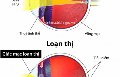 Loạn thị là gì? Phân biệt cận-viễn-loạn và cách điều trị