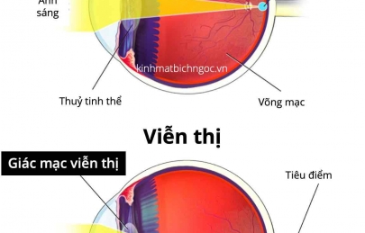 Phân biệt lão thị - viễn thị và 4 cách điều trị hiệu quả