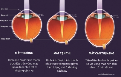 Cận thị bao nhiêu độ là nặng? Cận thị nặng có bị mù không?
