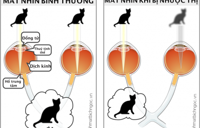 Nhược thị là gì? Nguyên nhân và cách điều trị
