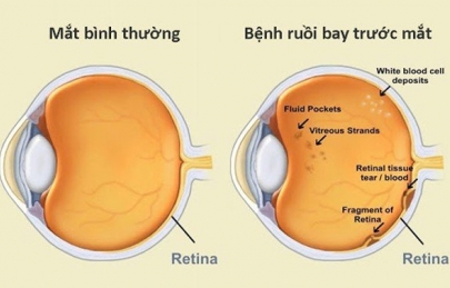Hiện tượng ruồi bay (Vẩn đục dịch kính): Nguyên nhân và cách chữa