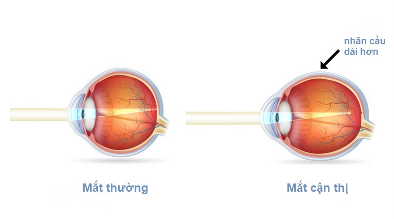 Mắt thường và mắt cận thị