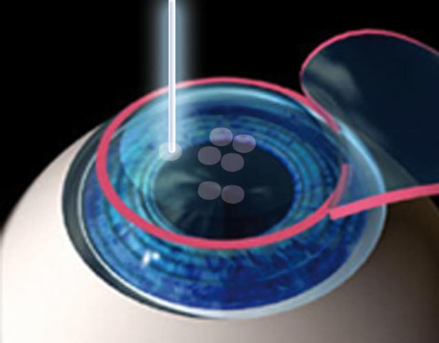 Phẫu thuật mắt cận thị bằng Laser