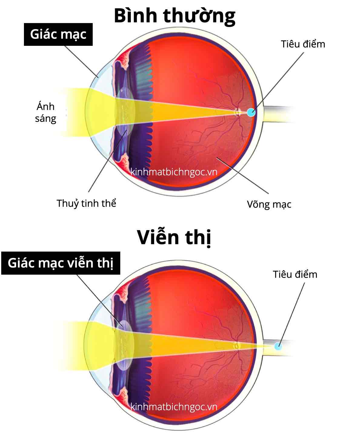 1. Giới Thiệu Về Kính Viễn Thị