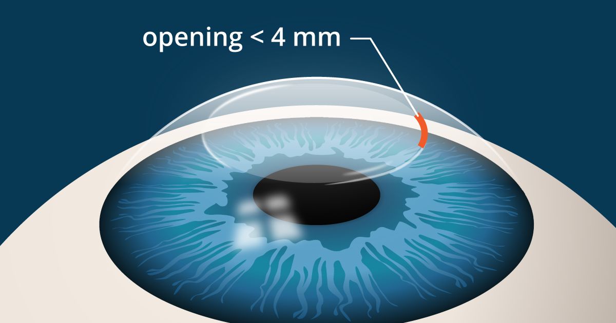 các loại hình phẫu thuật mắt cận thị