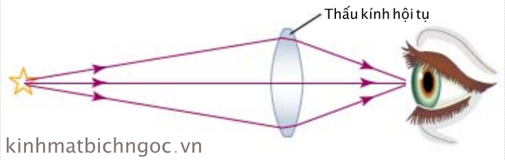 Có những dạng kính viễn thị nào khác nhau?
